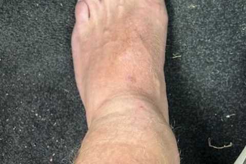 Jonny Bairstow shares gruesome pics of his broken leg as England star reveals horror injuries after ..