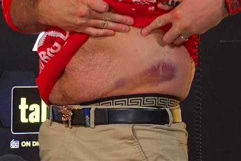 Tyson Fury shows off nasty bruise on waist after taking brutal body shots from Derek Chisora