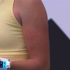 Australian Open Star Mirra Andreeva, 16, Reveals Gruesome Scars After Biting Her Own Arm in Anger..