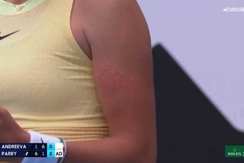 Australian Open Star Mirra Andreeva, 16, Reveals Gruesome Scars After Biting Her Own Arm in Anger..