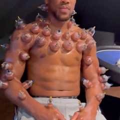 Anthony Joshua's Bizarre 'Hot Cupping' Treatment Leaves Fans Wincing