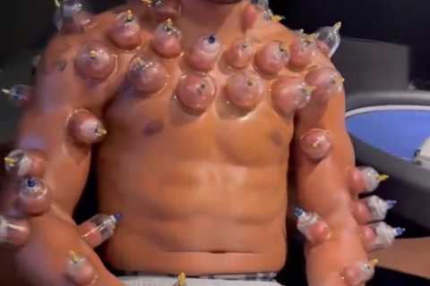Anthony Joshua's Bizarre 'Hot Cupping' Treatment Leaves Fans Wincing